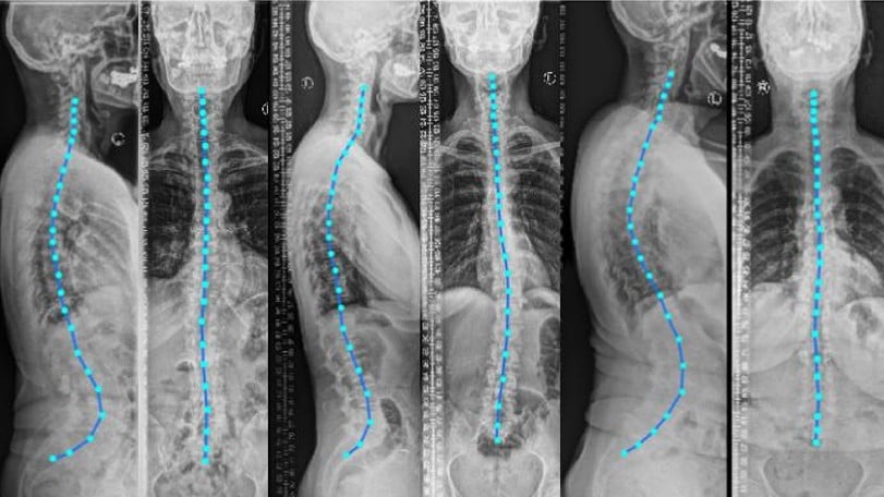 Deep Learning Automation: Breaking the 6-Hour Barrier in Spine Analysis 10 Core Applications of Deep Learning in Spine Diagnostics